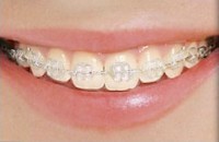 Inovação em Ortodontia